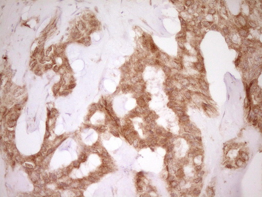 CD40 Antibody - IHC of paraffin-embedded Carcinoma of Human liver tissue using anti-CD40 mouse monoclonal antibody. (Heat-induced epitope retrieval by 1 mM EDTA in 10mM Tris, pH8.5, 120°C for 3min).