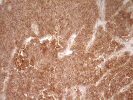 CD40 Antibody - IHC of paraffin-embedded Carcinoma of Human lung tissue using anti-CD40 mouse monoclonal antibody. (Heat-induced epitope retrieval by 1 mM EDTA in 10mM Tris, pH8.5, 120°C for 3min).