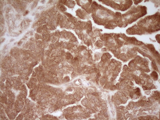 CD40 Antibody - IHC of paraffin-embedded Adenocarcinoma of Human ovary tissue using anti-CD40 mouse monoclonal antibody. (Heat-induced epitope retrieval by 1 mM EDTA in 10mM Tris, pH8.5, 120°C for 3min).