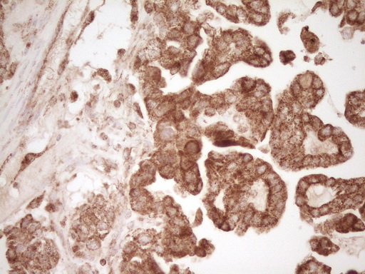 CD40 Antibody - Immunohistochemical staining of paraffin-embedded Adenocarcinoma of Human ovary tissue using anti-CD40 mouse monoclonal antibody. (Heat-induced epitope retrieval by Tris-EDTA, pH8.0)