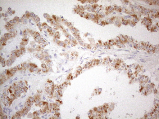 CD40 Antibody - Immunohistochemical staining of paraffin-embedded Carcinoma of Human thyroid tissue using anti-CD40 mouse monoclonal antibody. (Heat-induced epitope retrieval by 1mM EDTA in 10mM Tris buffer. (pH8.5) at 120°C for 3 min. (1:150)