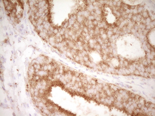 CD40 Antibody - Immunohistochemical staining of paraffin-embedded Adenocarcinoma of Human breast tissue using anti-CD40 mouse monoclonal antibody. (Heat-induced epitope retrieval by Tris-EDTA, pH8.0)