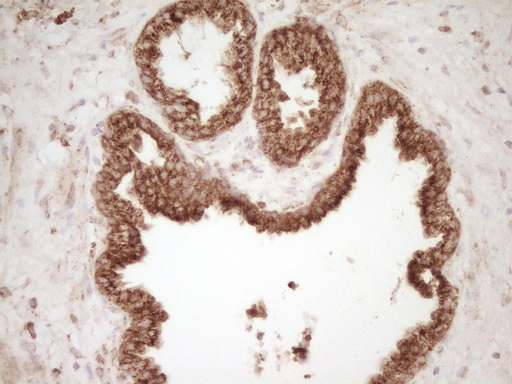 CD40 Antibody - Immunohistochemical staining of paraffin-embedded Carcinoma of Human prostate tissue using anti-CD40 mouse monoclonal antibody. (Heat-induced epitope retrieval by Tris-EDTA, pH8.0)