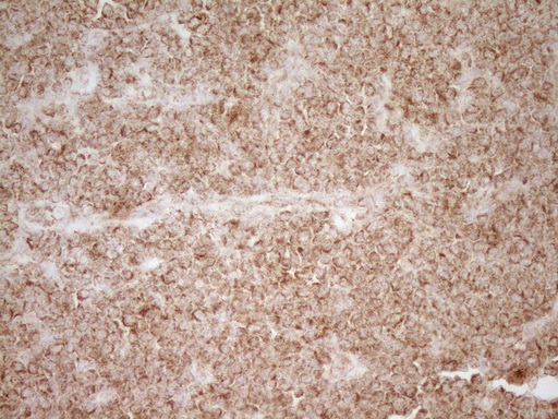 CD40 Antibody - Immunohistochemical staining of paraffin-embedded Human lymphoma tissue using anti-CD40 mouse monoclonal antibody. (Heat-induced epitope retrieval by Tris-EDTA, pH8.0)