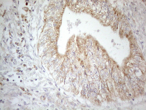 CD40 Antibody - Immunohistochemical staining of paraffin-embedded Adenocarcinoma of Human colon tissue using anti-CD40 mouse monoclonal antibody. (Heat-induced epitope retrieval by 1mM EDTA in 10mM Tris buffer. (pH8.5) at 120°C for 3 min. (1:150)