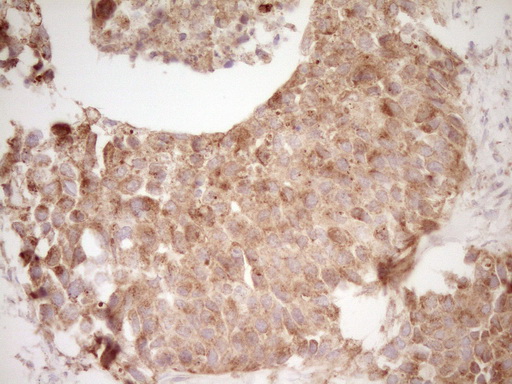 CD40 Antibody - Immunohistochemical staining of paraffin-embedded Carcinoma of Human kidney tissue using anti-CD40 mouse monoclonal antibody. (Heat-induced epitope retrieval by Tris-EDTA, pH8.0)
