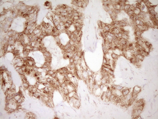 CD40 Antibody - Immunohistochemical staining of paraffin-embedded Carcinoma of Human liver tissue using anti-CD40 mouse monoclonal antibody. (Heat-induced epitope retrieval by Tris-EDTA, pH8.0)