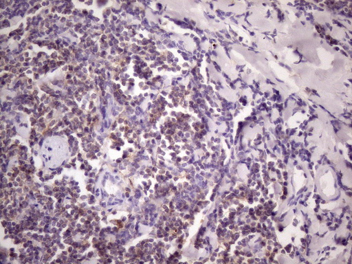CD40 Antibody - IHC of paraffin-embedded Human lymphoma tissue using anti-CD40 mouse monoclonal antibody. (Heat-induced epitope retrieval by 1 mM EDTA in 10mM Tris, pH8.5, 120°C for 3min)(1:150).