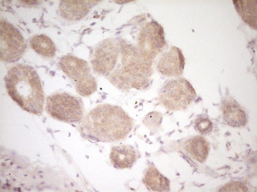 CD40 Antibody - IHC of paraffin-embedded Adenocarcinoma of Human breast tissue using anti-CD40 mouse monoclonal antibody. (Heat-induced epitope retrieval by 1 mM EDTA in 10mM Tris, pH8.5, 120°C for 3min).