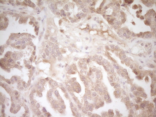 CD40 Antibody - IHC of paraffin-embedded Adenocarcinoma of Human ovary tissue using anti-CD40 mouse monoclonal antibody. (Heat-induced epitope retrieval by 1 mM EDTA in 10mM Tris, pH8.5, 120°C for 3min).