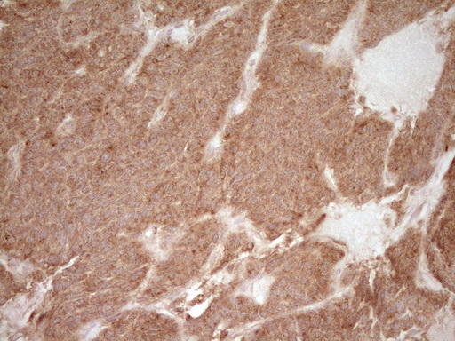 CD40 Antibody - IHC of paraffin-embedded Carcinoma of Human lung tissue using anti-CD40 mouse monoclonal antibody. (Heat-induced epitope retrieval by 1 mM EDTA in 10mM Tris, pH8.5, 120°C for 3min).