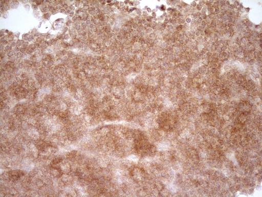 CD40 Antibody - IHC of paraffin-embedded Human lymphoma tissue using anti-CD40 mouse monoclonal antibody. (Heat-induced epitope retrieval by 1 mM EDTA in 10mM Tris, pH8.5, 120°C for 3min).