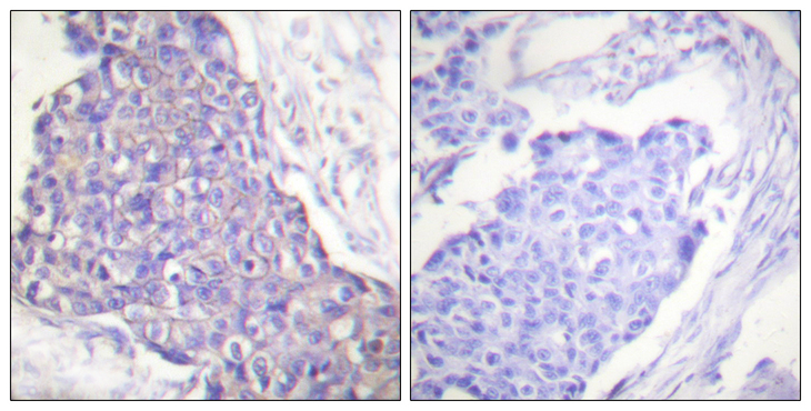 CD40 Antibody - Immunohistochemistry analysis of paraffin-embedded human breast carcinoma tissue, using CD40 Antibody. The picture on the right is blocked with the synthesized peptide.