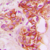 CD40 Antibody - Immunohistochemical analysis of CD40 staining in human breast cancer formalin fixed paraffin embedded tissue section. The section was pre-treated using heat mediated antigen retrieval with sodium citrate buffer (pH 6.0). The section was then incubated with the antibody at room temperature and detected using an HRP conjugated compact polymer system. DAB was used as the chromogen. The section was then counterstained with hematoxylin and mounted with DPX.