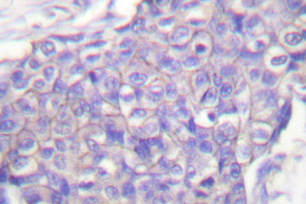 CD40 Antibody - IHC of CD40 (Q259) pAb in paraffin-embedded human breast carcinoma brain tissue.