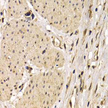 CD40 Antibody - Immunohistochemistry of paraffin-embedded human stomach cancer tissue.