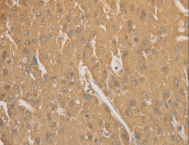 CD40 Antibody - Immunohistochemistry of paraffin-embedded Human gastric cancer using CD40 Polyclonal Antibody at dilution of 1:70.