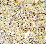 CD40L Antibody - TRAP Antibody IHC of formalin-fixed and paraffin-embedded kidney carcinoma followed by peroxidase-conjugated secondary antibody and DAB staining.