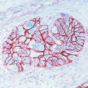 CD44 Antibody - Formalin-fixed, paraffin-embedded human esophageal carcinoma stained with peroxidase-conjugate and AEC chromogen. Note cell membrane staining of tumor cells.  This image was taken for the unconjugated form of this product. Other forms have not been tested.
