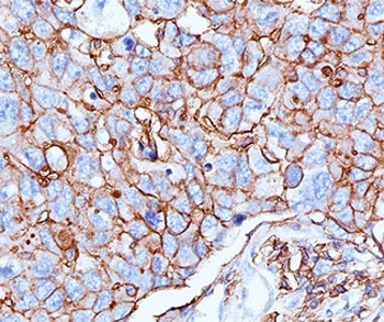 CD44 Antibody - HCAM antibody 156-3C11 immunohistochemistry breast.  This image was taken for the unmodified form of this product. Other forms have not been tested.
