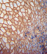 CD44 Antibody - CD44 antibody immunohistochemistry of formalin-fixed and paraffin-embedded human esophagus carcinoma followed by peroxidase-conjugated secondary antibody and DAB staining.
