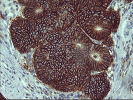 CD44 Antibody - IHC of paraffin-embedded Carcinoma of Human pancreas tissue using anti-CD44 mouse monoclonal antibody. (heat-induced epitope retrieval by 1 mM EDTA in 10mM Tris, pH8.5, 120°C for 3min).