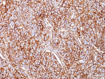 CD44 Antibody - Formalin-fixed, paraffin-embedded human breast carcinoma stained with CD44 antibody (SPM521).  This image was taken for the unmodified form of this product. Other forms have not been tested.