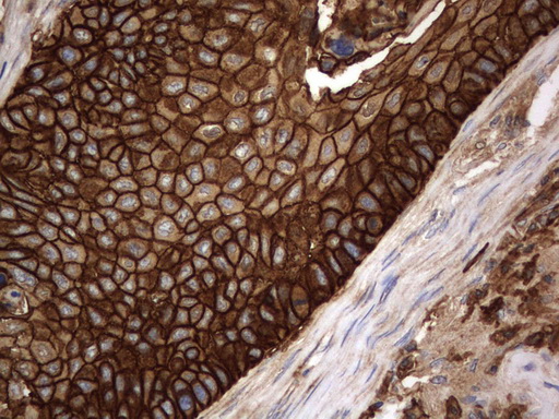 CD44 Antibody - Immunohistochemical staining of paraffin-embedded Carcinoma of Human lung tissue using anti-CD44mouse monoclonal antibody.  heat-induced epitope retrieval by 10mM citric buffer, pH6.0, 120C for 3min)