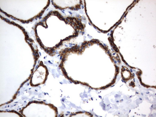 CD44 Antibody - Immunohistochemical staining of paraffin-embedded Human thyroid tissue using anti-CD44 mouse monoclonal antibody.  heat-induced epitope retrieval by 10mM citric buffer, pH6.0, 120C for 3min)