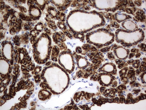 CD44 Antibody - Immunohistochemical staining of paraffin-embedded Carcinoma of Human thyroid tissue using anti-CD44 mouse monoclonal antibody.  heat-induced epitope retrieval by 10mM citric buffer, pH6.0, 120C for 3min)