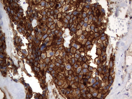 CD44 Antibody - Immunohistochemical staining of paraffin-embedded Adenocarcinoma of Human breast tissue using anti-CD44 mouse monoclonal antibody.  heat-induced epitope retrieval by 10mM citric buffer, pH6.0, 120C for 3min)