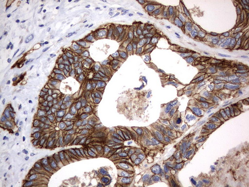 CD44 Antibody - Immunohistochemical staining of paraffin-embedded Adenocarcinoma of Human colon tissue using anti-CD44 mouse monoclonal antibody.  heat-induced epitope retrieval by 10mM citric buffer, pH6.0, 120C for 3min)