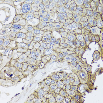 CD44 Antibody - Immunohistochemistry of paraffin-embedded human lung cancer using CD44 antibody at dilution of 1:100 (40x lens).