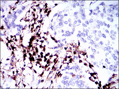 CD45 / LCA Antibody - IHC of paraffin-embedded breast cancer tissues using PTPRC mouse monoclonal antibody with DAB staining.