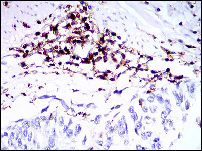CD45 / LCA Antibody - IHC of paraffin-embedded esophageal cancer tissues using PTPRC mouse monoclonal antibody with DAB staining.