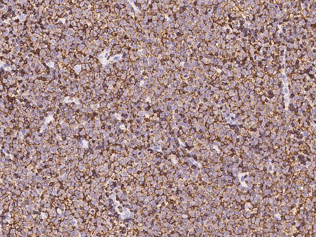 CD45 / LCA Antibody - Immunochemical staining of human LCA in human lymphoma with rabbit monoclonal antibody at 1:200 dilution, formalin-fixed paraffin embedded sections.