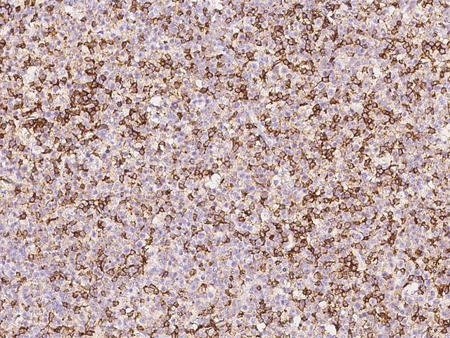 CD45 / LCA Antibody - Immunochemical staining of human PTPRC in human lymphoma with mouse monoclonal antibody at 1:5000 dilution, formalin-fixed paraffin embedded sections.