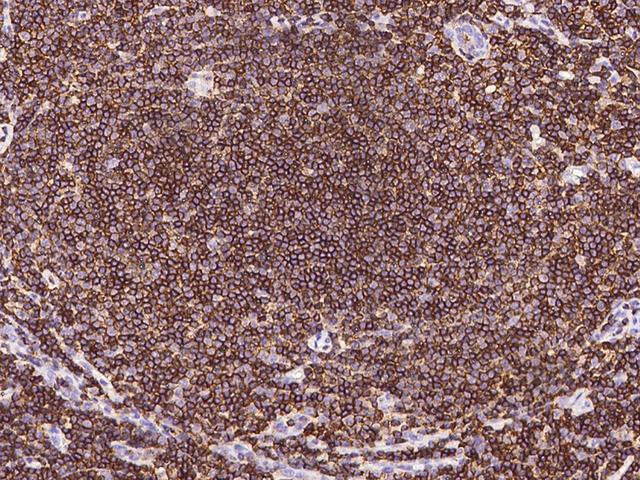 CD45 / LCA Antibody - Immunochemical staining of mouse PTPRC in human lymphoma with mouse monoclonal antibody at 1:60 dilution, formalin-fixed paraffin embedded sections.