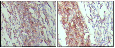 CD45 / LCA Antibody - IHC of paraffin-embedded human lymph node tissue,showing membrane and cytoplasmic localization with DAB staining using CD45 mouse monoclonal antibody.