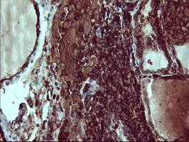 CD45 / LCA Antibody - IHC of paraffin-embedded Human thyroid tissue using anti-PTPRC mouse monoclonal antibody. (Heat-induced epitope retrieval by 10mM citric buffer, pH6.0, 120°C for 3min).