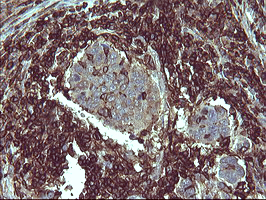 CD45 / LCA Antibody - IHC of paraffin-embedded Carcinoma of Human lung tissue using anti-PTPRC mouse monoclonal antibody.