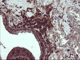 CD45 / LCA Antibody - IHC of paraffin-embedded Carcinoma of Human prostate tissue using anti-PTPRC mouse monoclonal antibody.