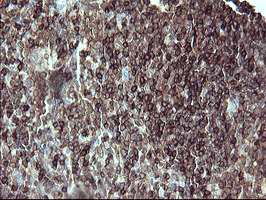 CD45 / LCA Antibody - IHC of paraffin-embedded Human lymphoma tissue using anti-PTPRC mouse monoclonal antibody.