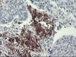 CD45 / LCA Antibody - IHC of paraffin-embedded Carcinoma of Human lung tissue using anti-PTPRC mouse monoclonal antibody.