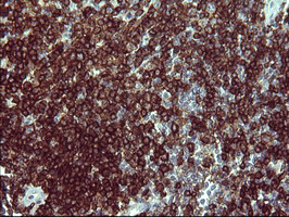 CD45 / LCA Antibody - IHC of paraffin-embedded Human lymphoma tissue using anti-PTPRC mouse monoclonal antibody. (heat-induced epitope retrieval by 1 mM EDTA in 10mM Tris, pH8.5, 120°C for 3min).