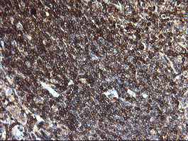 CD45 / LCA Antibody - IHC of paraffin-embedded Human lymphoma tissue using anti-PTPRC mouse monoclonal antibody.