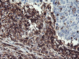 CD45 / LCA Antibody - IHC of paraffin-embedded Carcinoma of Human lung tissue using anti-PTPRC mouse monoclonal antibody.