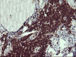 CD45 / LCA Antibody - IHC of paraffin-embedded Human thyroid tissue using anti-PTPRC mouse monoclonal antibody.