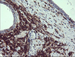 CD45 / LCA Antibody - IHC of paraffin-embedded Carcinoma of Human prostate tissue using anti-PTPRC mouse monoclonal antibody.