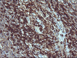 CD45 / LCA Antibody - IHC of paraffin-embedded Human lymphoma tissue using anti-PTPRC mouse monoclonal antibody.